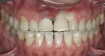 Figure 11  Preoperative photograph of a case in which the patient refused surgery and orthodontics. The treatment goal was to do minimal preparation and use a tough material due to the general medium-to-high risk in every area; obtaining a seal was p