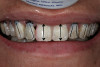 Figure 2  Dental caries is usually seen in cervical and incisal surfaces.