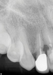 Pretreatment periapical radiograph of the area of teeth Nos. 7 and 8, showing the root resorption.