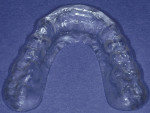 Figure 11  Initial nightguard verifying evidence of nocturnal bruxism.