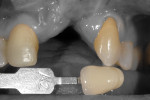 Fig 3.
A digital dental camera (EyeSpecial C-III, Shofu, shofu.com) was used to relay the cervical shade utilizing the “isolate shade”
feature, which deemphasizes the gingiva and background for optimal shade matching.