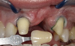 Fig 4. A mid-operative view of the
preparations. The shade of the final preparations will be provided to the laboratory. Effective communication of the shade
is especially important for highly translucent restorations