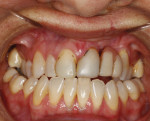 BEFORE. Intraoral view of patient before orthodontic therapy.
