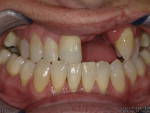 Fig 2. Postorthodontic treatment evaluation of remaining dentition. The patient was happy with the appearance
of her teeth and resultant bite, thus it was opted to treat conservatively and restore teeth Nos. 7 through 11.