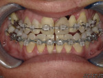 Fig 1. Final evaluation of midline and restorative
space for the final prosthesis before restorative treatment and debonding. (Orthodontics: David C. McReynolds, DDS,
MS, Keller, Texas)
