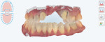 Fig 6. A colorized view of the final impressions using the iTero Element 2 scanner. Digital scans enabled the lab to work efficiently, eliminating guesswork on margins and occlusal clearance.