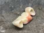Fig 8. The intaglio view of the final restoration, fabricated using a low-translucency zirconia
coping (IPS e.max® ZirCAD® LT, Ivoclar Vivadent, ivoclarvivadent.com) with feldspar veneer porcelain (VITA VM®9, VITA North
America, vitanorthamerica.com) and various shades of glazes (MiYO®, Jensen Dental, jensendental.com) for staining and gingival
effects. Gingival tissue was incorporated into the restoration to fill the void created from the patient’s cleft palate. Direct
composite resin (Evanesce™, Clinician’s Choice, clinicianschoice.com) (not shown) was placed on the maxillary right lateral
incisor. (Laboratory work: Aaron Hoffman, Sunflower Dental Studio, Topeka, Kansas)