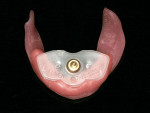 Figure 11  Maxillary and mandibular record bases with central bearing device mounted using light-activated laboratory resin.