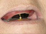Figure 17  The central bearing device in place. The patient was instructed to make mandibular movements through all eccentric positions