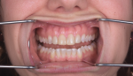 Fig 4. A present-day pre-operative photograph of the patient reveals incisor discoloration, her chief complaint.
