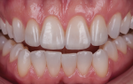 Fig 18. Six months after the restoration, intraoral and extraoral images show a much more esthetic smile.