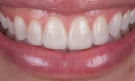 Fig 19. Six months after the restoration, intraoral and extraoral images show a much more esthetic smile.