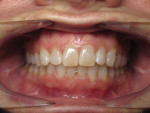 Retracted facial view after completion of clear aligner treatment.
