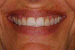 Preoperative close-up smile photograph.