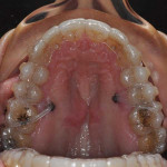 Occlusal view of the maxillary aligner in place with the elastics attached to the bone plate anchors.