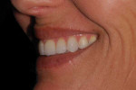 Final left lateral smile photograph.