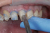 Figure 6  Maxillary alveolar ridge after endodontic therapy and crown amputation of the maxillary central incisors.