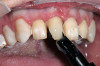 Figure 12  Maxillary and mandibular complete dentures at occlusion in the mouth.