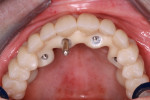 The laboratory-fabricated trial denture was placed to verify the bite, lip line, smile line, overjet, overbite, and smile design.