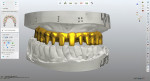 The framework design was based on the design of the approved denture to ensure optimal tissue and tooth display.