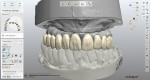 The crown design, which was selected from the laboratory’s library, followed the form and shape of the denture teeth from the pre preparation model.