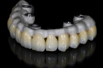 The milled zirconia full-contour crowns on the framework after glazing.