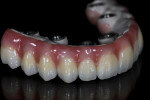 Pink composite was applied in a progressive layering process to create the gingiva.
