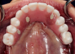 Occlusal view of the immediate maxillary prosthesis on the day of surgery.