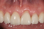Figure 24  Final restorations maxillary anterior teeth Nos. 6 to 11.