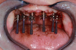 Fig 4. Impression copings were used to capture an implant-level open tray impression.