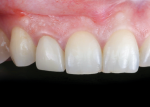 Postoperative image of the final screw retained ceramic restoration, which was fabricated on a stock 1-mm cuff height zirconia abutment.