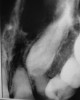 Figure 2  A radiograph finds no pulp chamber in the slightly dark central incisor and a silver point on the darkest lateral incisor. A titrated approach to bleaching was needed using individual tooth treatments.