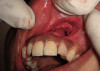 Figure 4  Endodontic therapy was attempted on a tooth with calcific metamorphosis, with subsequent perforation and file fracture in the PDL.