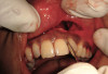 Figure 5  Trimming the cast only from the base (with the central incisors horizontal) until the vestibule is removed and a hole occurs in the palate will avoid the danger of damaging teeth from traditional trimming as well as create the best cast for use in a vacuum-former.
