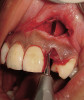 Figure 6  A single dark tooth from trauma needs to be examined carefully and evaluated with a radiograph. The safest approach is to bleach this tooth alone until the toothís response and maximum lightening can be determined.
