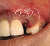 Figure 12  The initial examination and radiograph determined that the dark lateral incisor was abscessed. After endodontic therapy, the tooth was then ready for bleaching. Had bleaching been performed without the radiograph, the abscess would have remained untreated and further damaged the tooth.