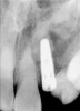 Figure 13   The endodontic access opening should be enlarged until it can be certain that all the remaining brown pulp tissue has been removed from the lateral walls of the pulp chamber as well as the incisal extent. Pulps that became necrotic when the tooth was young often have pulp chambers much larger than the endodontic access opening.