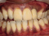 Figure 15  For internal bleaching, the gutta-percha should be removed 2 mm below the CEJ.