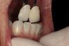 Figure 18  After the tooth being bleached has reached its maximum lightening, the bleaching process should be stopped for 2 weeks to allow the shade to stabilize and the bond strengths to return to normal. Then an opaque whiter composite can be placed in the chamber if needed to further harmonize the tooth color.