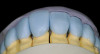 Figure 19  The endodontically treated canine is much darker than the adjacent teeth, but in this less-esthetic area, a full tray was used to lighten all the teeth. The canine was bleached internally with one treatment and externally to completion.