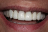 Figure 20  After 3 weeks of external bleaching with 10% carbamide peroxide at night, the adjacent teeth reached their maximum lightness. While the other teeth are slightly lighter than the canine, the color match was much closer and pleasing to the patient.