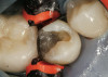 Figure 3  White spot lesions evident after orthodontic therapy (photograph courtesy of S. Paris and H. Meyer-Lueckel).