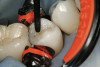 Figure 4  White spot lesions are imperceptible, blending with natural tooth color, after caries infiltration therapy (photograph courtesy of S. Paris and H. Meyer-Lueckel).