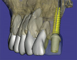 Figure 5  A 3D reconstruction of a maxilla showing an implant with a realistic abutment and virtual tooth.
