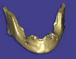 Figure 6  A 3D reconstruction of a mandibular arch with a high alveolus requiring reduction.