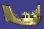 Figure 8  The segmented alveolus hovering over the virtual placement of four implants.