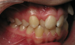 Figure 3  Preoperative retracted lateral view shows the severity of the tooth position issue.