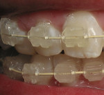 Figure 7  Close-up photograph of the Six Month Smiles brackets and wires during treatment. The short treatment times and discreet brackets create an attractive scenario for adults with crooked teeth.