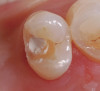 Figure 17  ral presentation of LE around the gingiva.