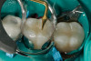 Figure 7  This patient had severe crowding with completely blocked-out canines. Premolar extraction appears to be inevitable.